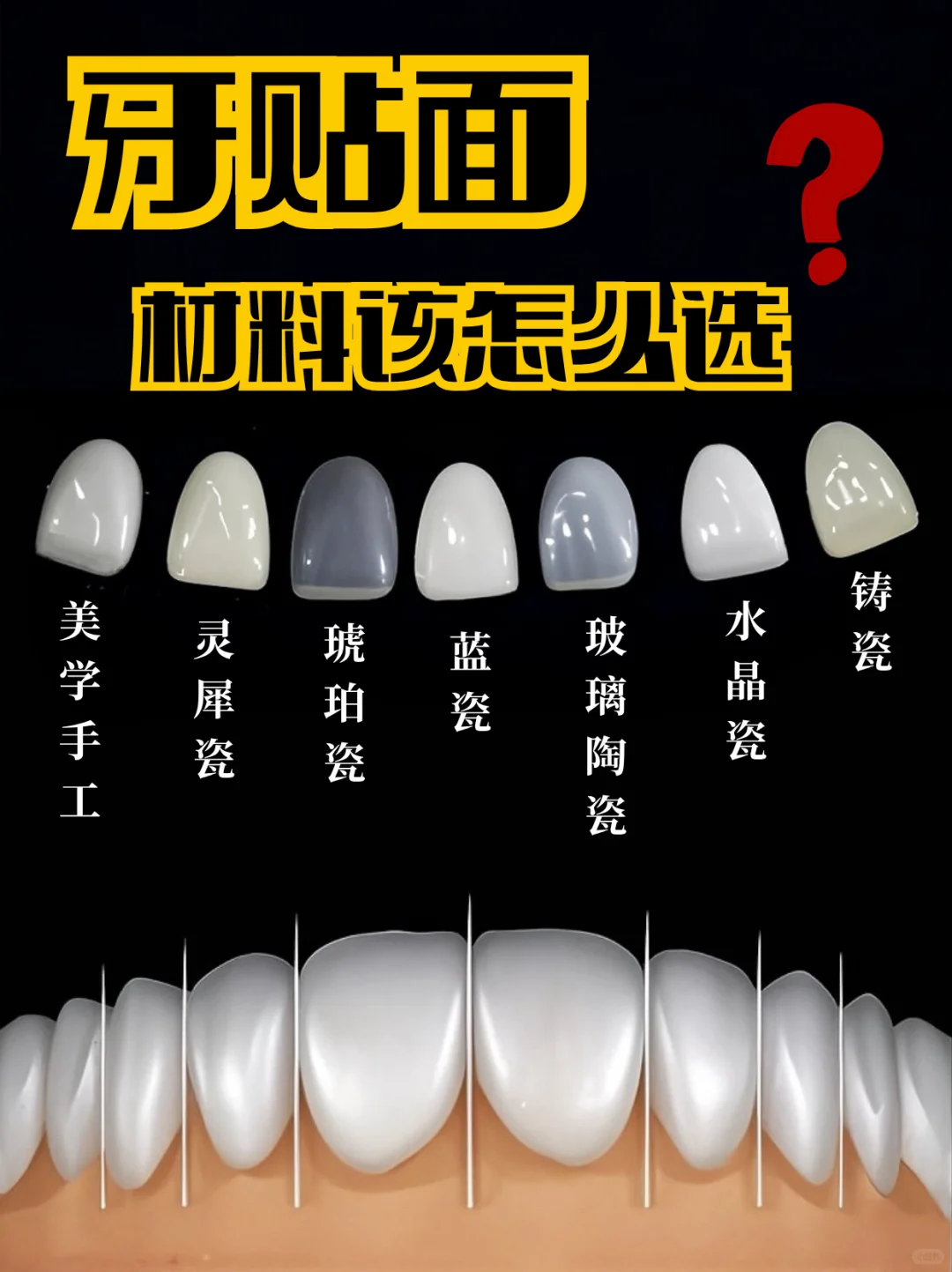 牙贴面材料选对不选贵！