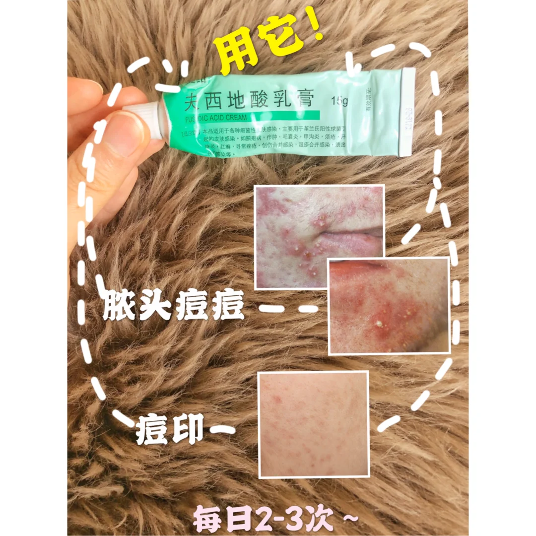 消灭痘痘就用三甲医院的这三支神仙药膏!