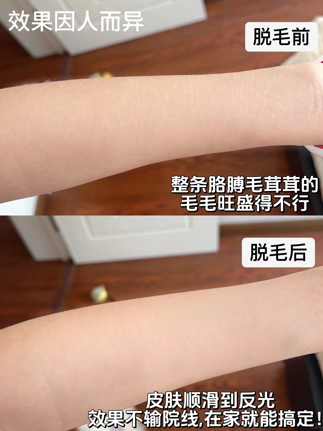 各大脱毛仪继续卷！双十一我只选SHR！！