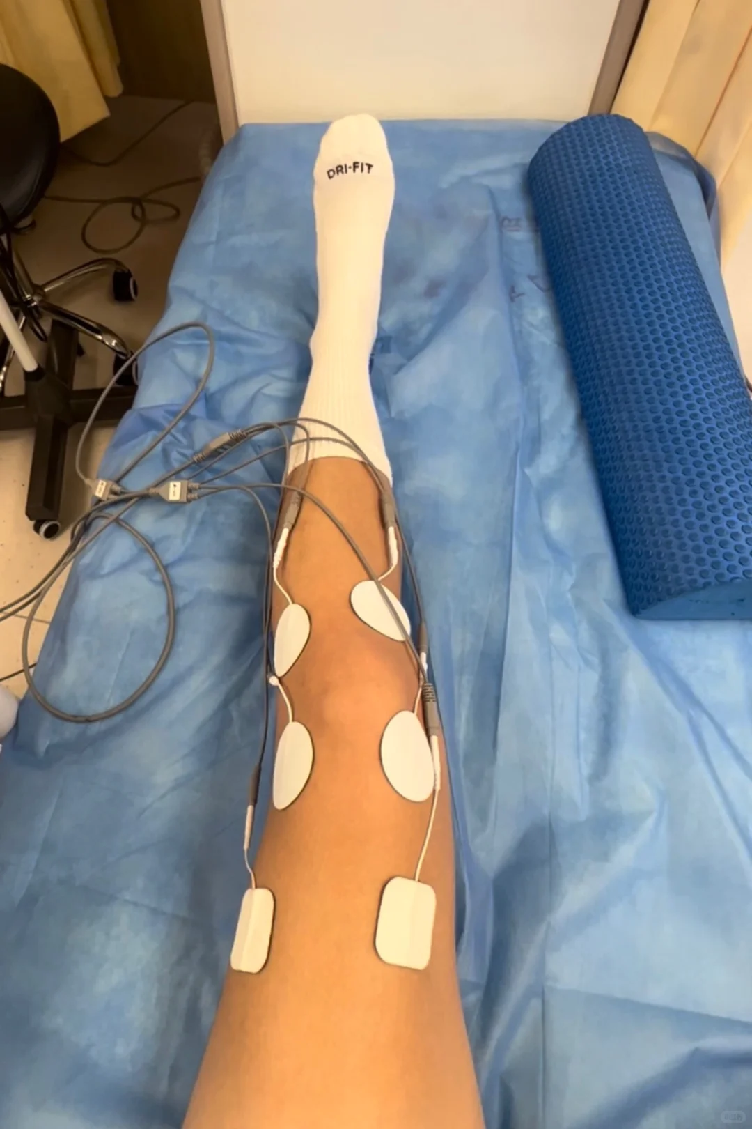 半月板撕裂｜针灸+电疗+激活+松解