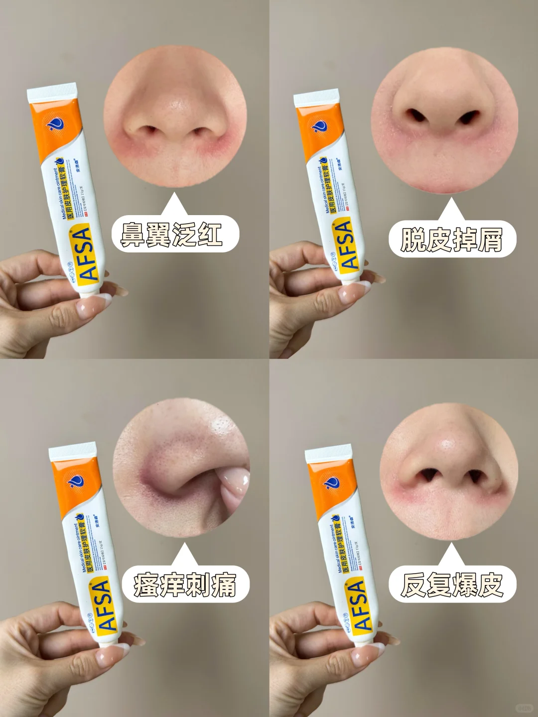 鼻翼两侧脂溢性皮炎人群看过来!