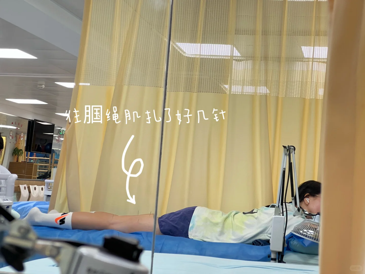 半月板撕裂｜针灸+电疗+激活+松解