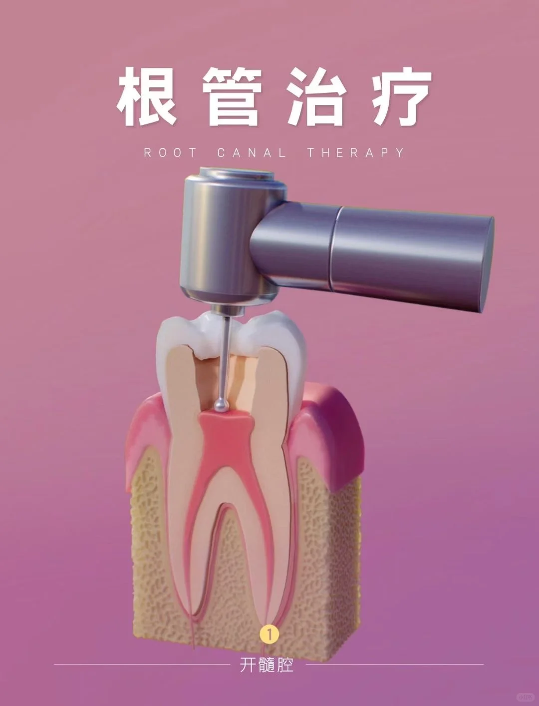 你知道根管主要是什么样的吗