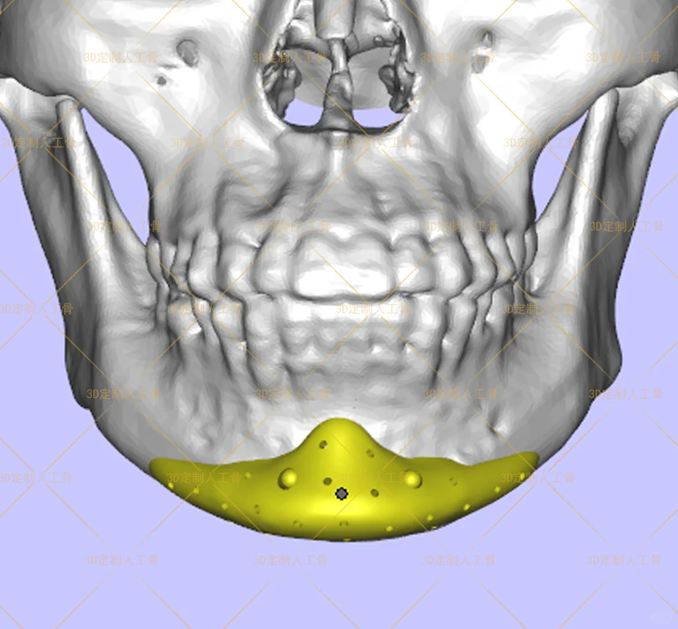 可以定制的假体PEEK！