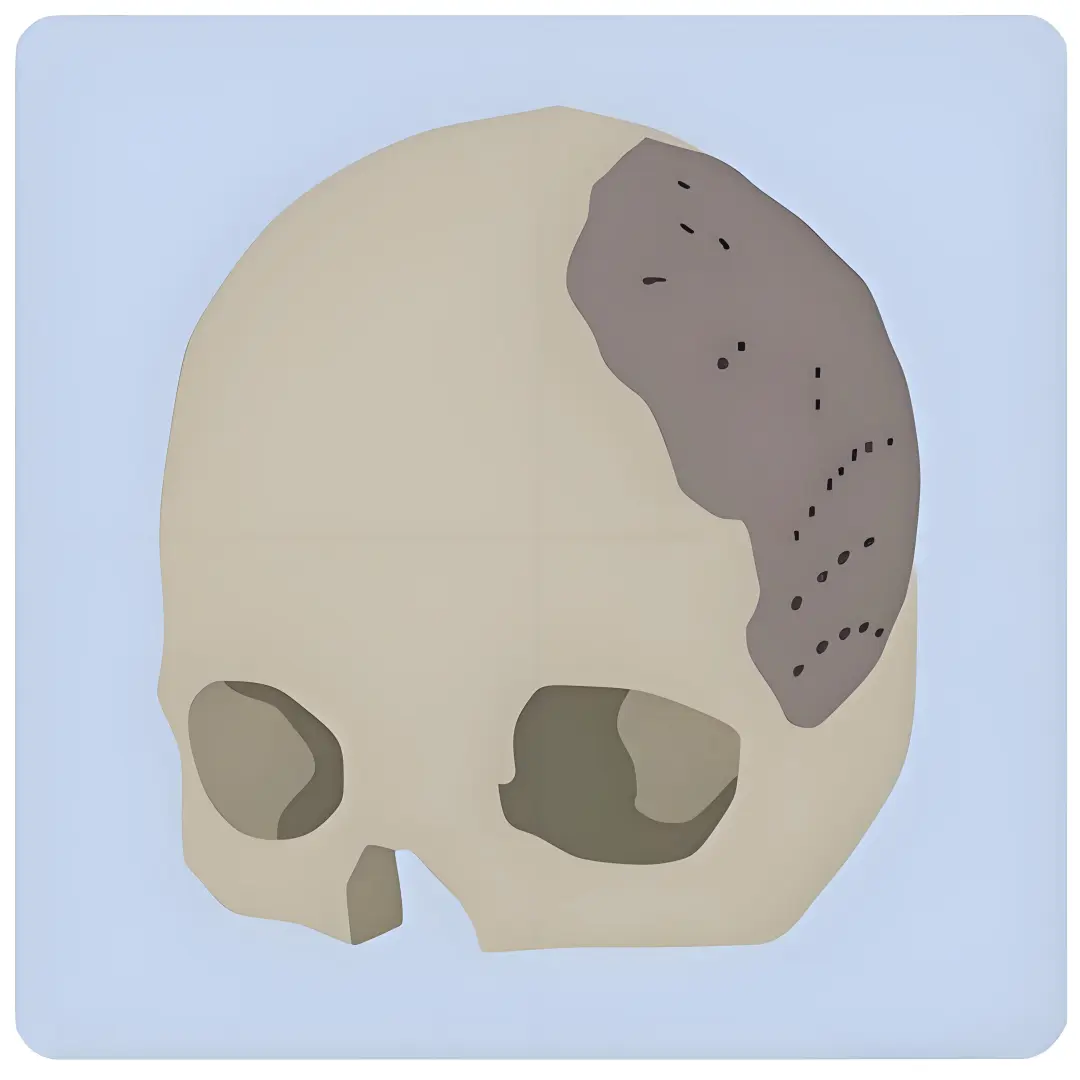 PEEK vs 自体骨:颅骨修补材料选择指南!