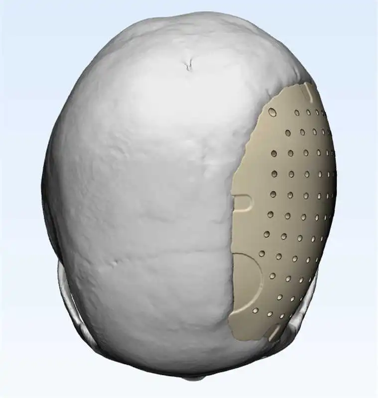 PEEK颅骨修补术后复查,组织相容性超预期!