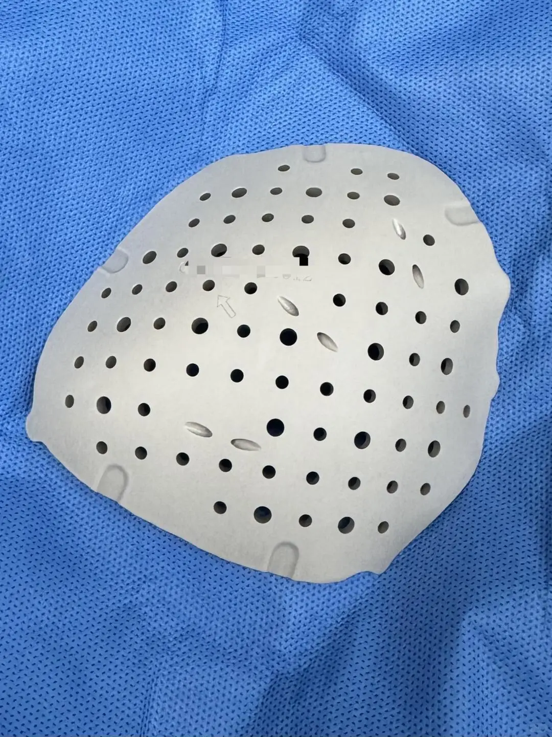 PEEK颅骨修补帮助高空坠落患者成功修复颅骨