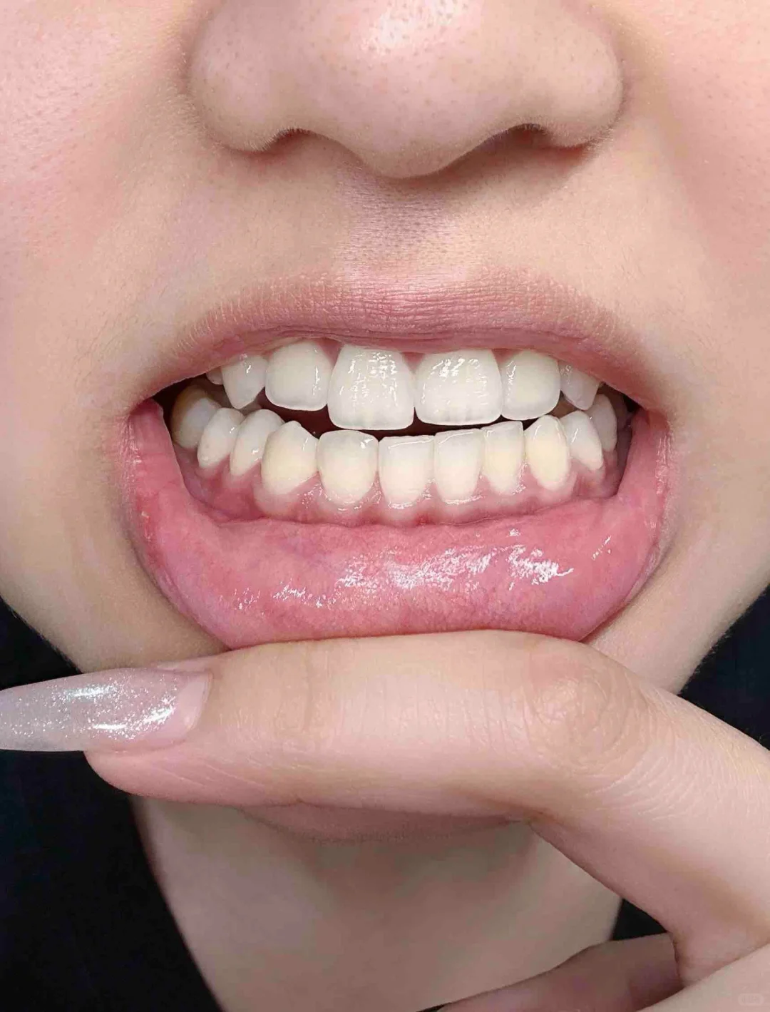 坚持维c刷牙第42天…(牙周炎)