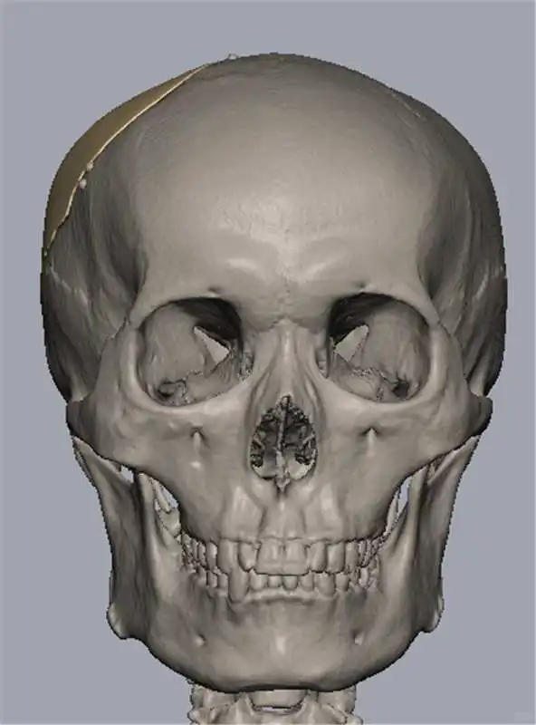 PEEK颅骨修补术后复查,组织相容性超预期!