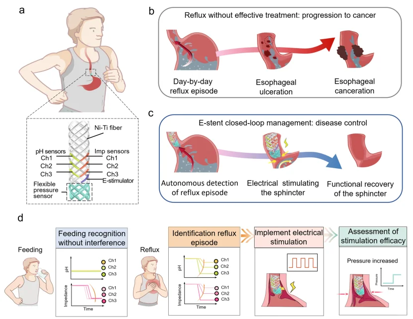 胃食管反流病实时管理无创闭环生物电子支架