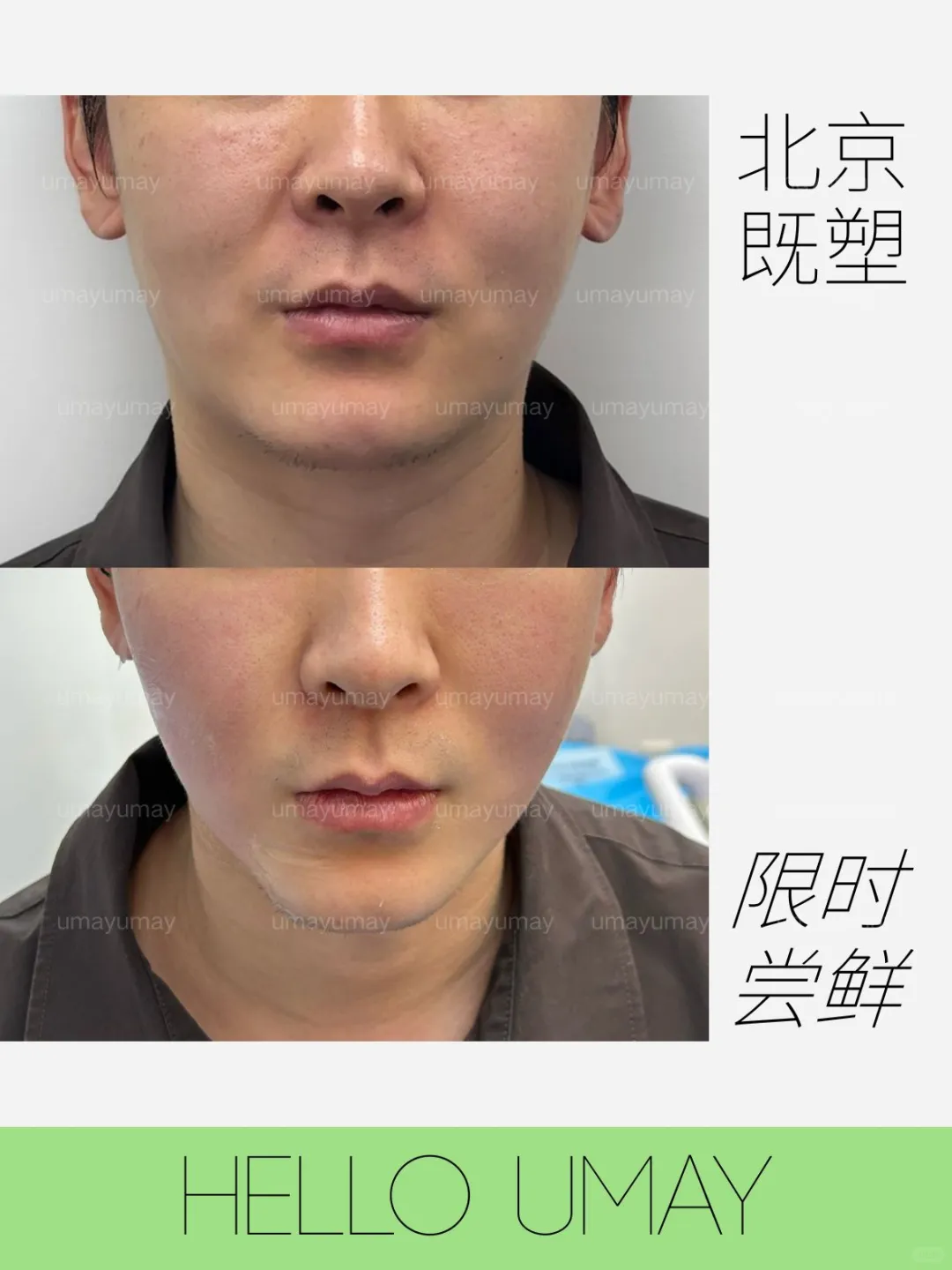 3D既塑，溶脂大宝贝，超赞的