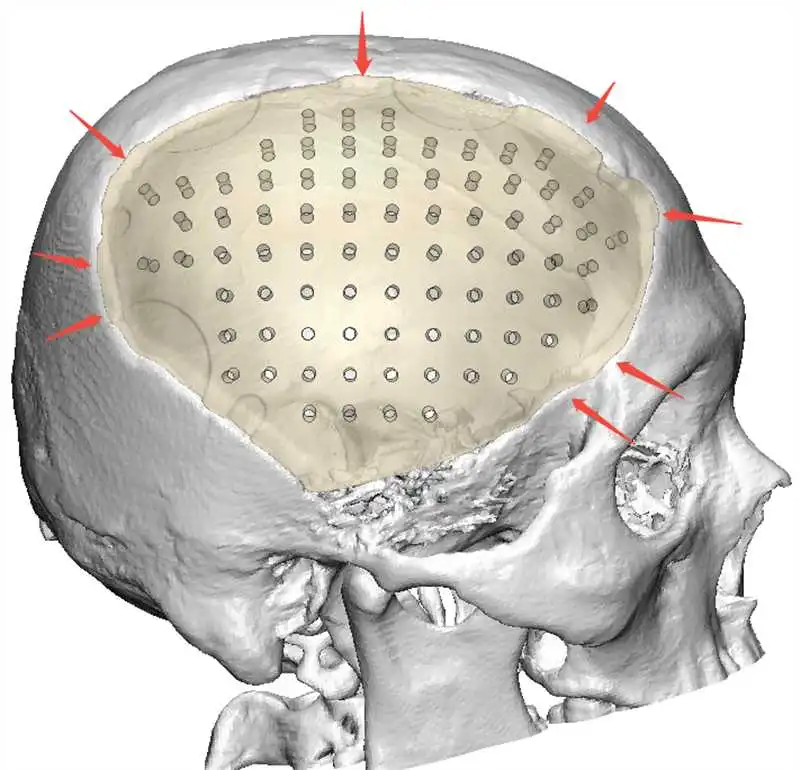 PEEK颅骨修补:医生解析外漏可能性!