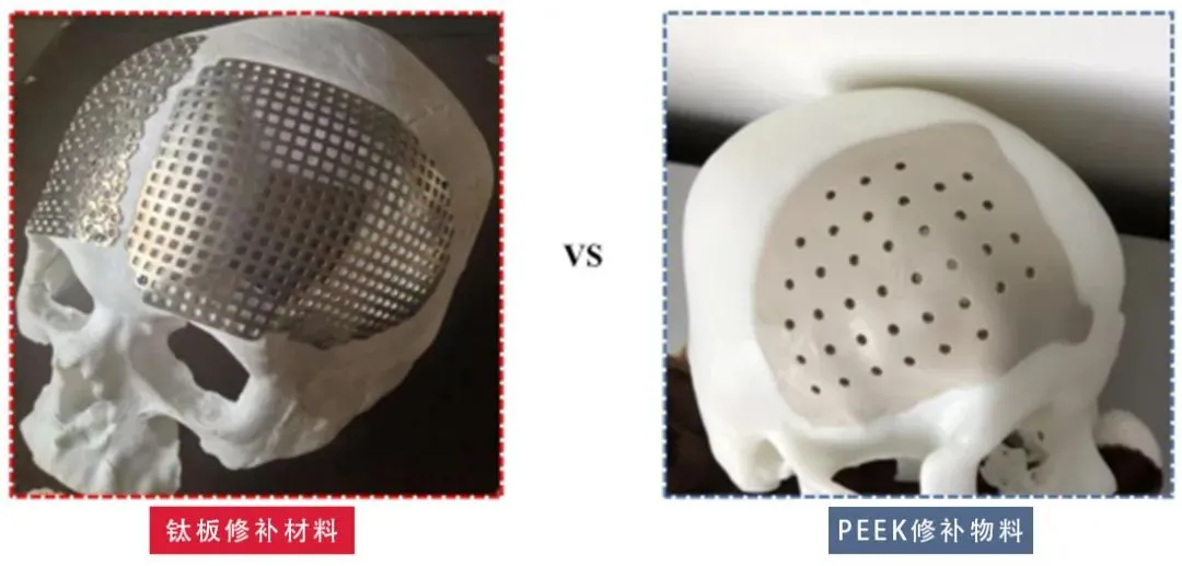 颅骨修补|医生告诉你PEEK的适应症与禁忌症