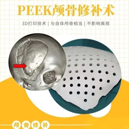 颅骨修补|医生告诉你PEEK的适应症与禁忌症