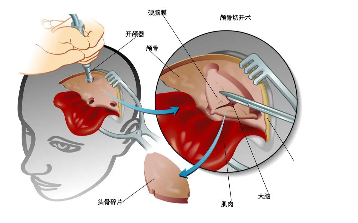 脑出血康复的关键:PEEK颅骨修补的核心优势