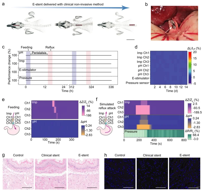 胃食管反流病实时管理无创闭环生物电子支架