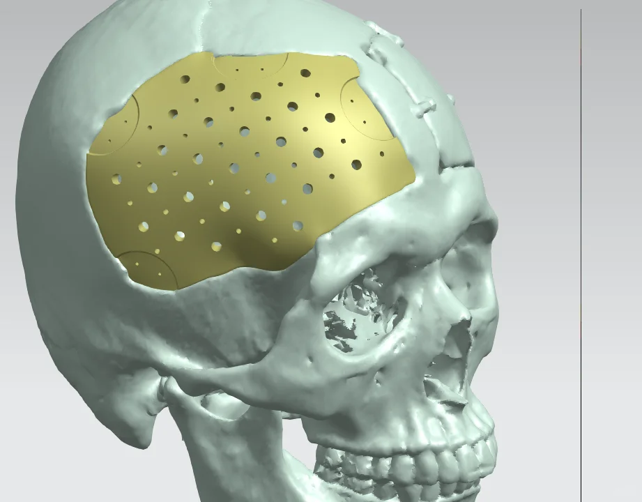 PEEK颅骨修补的术后护理有哪些