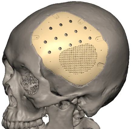 PEEK为何是天花板级材料?