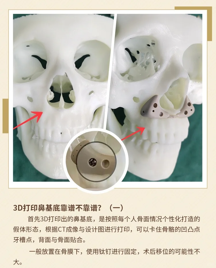 3D打印鼻基底