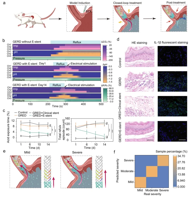胃食管反流病实时管理无创闭环生物电子支架