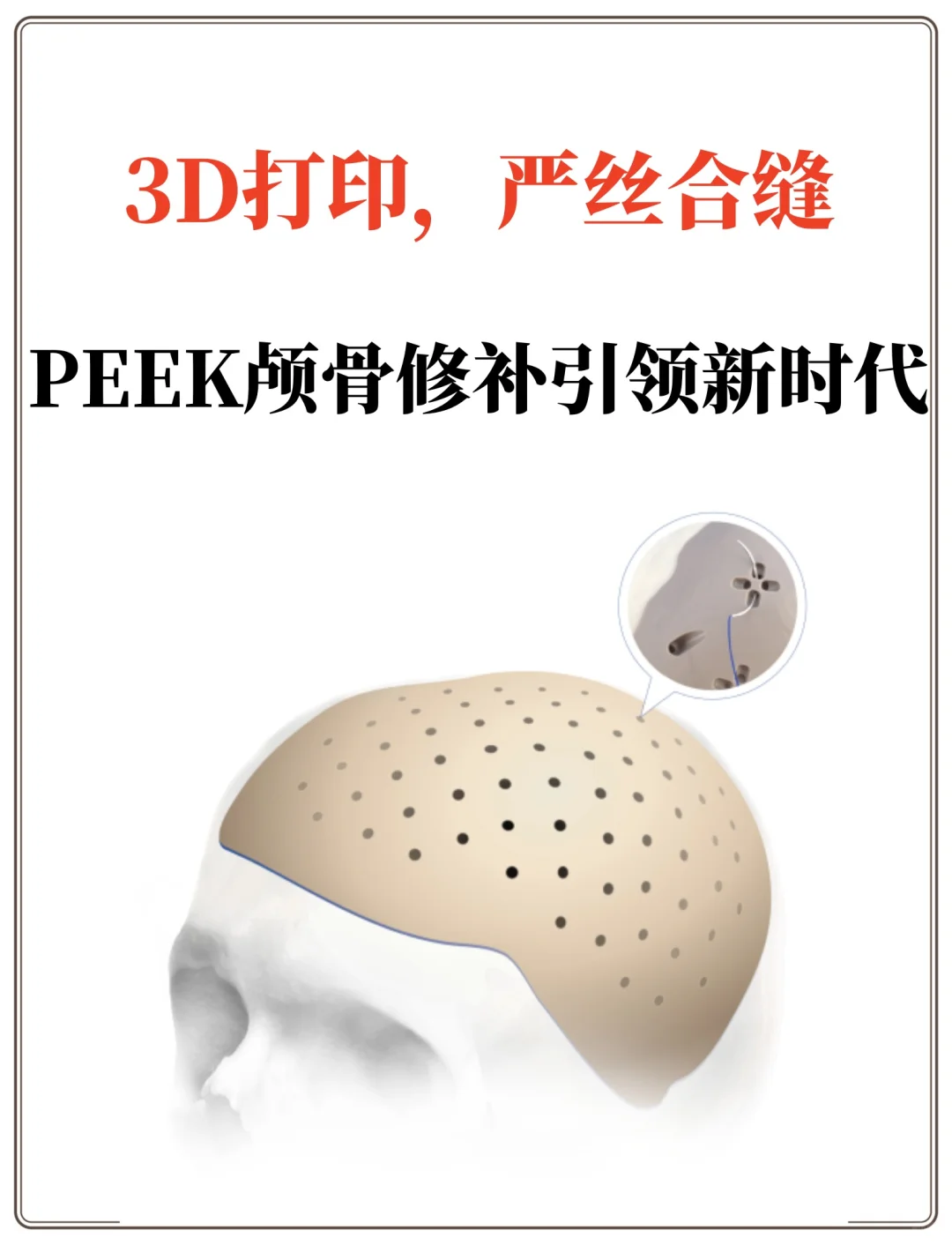 3D打印,严丝合缝！PEEK颅骨修补引领新时代