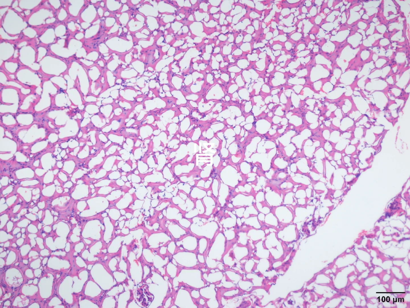 心肝脾肺肾肿瘤HE染色
