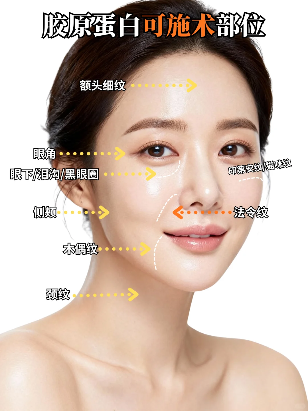 ??Orbit丨胶原蛋白可施术部位