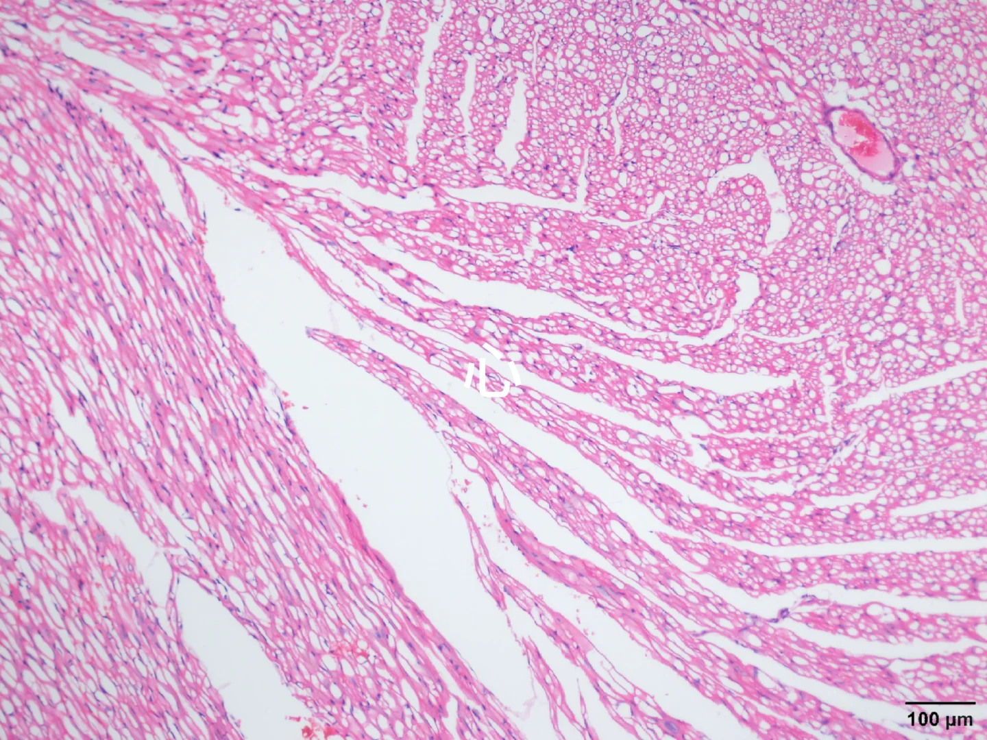 心肝脾肺肾肿瘤HE染色