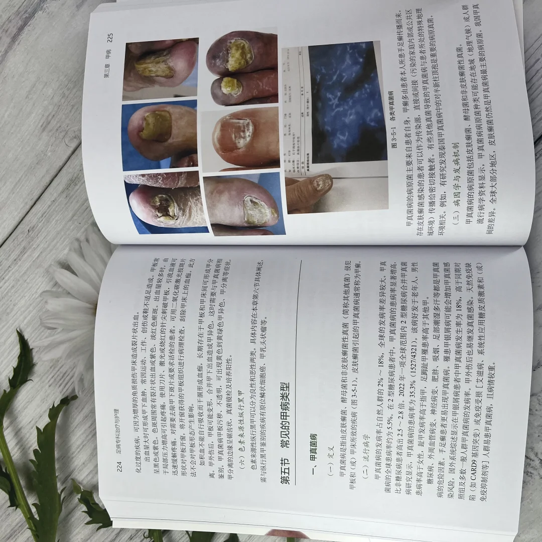 糖尿病足、甲病……找到了治疗、护理方法