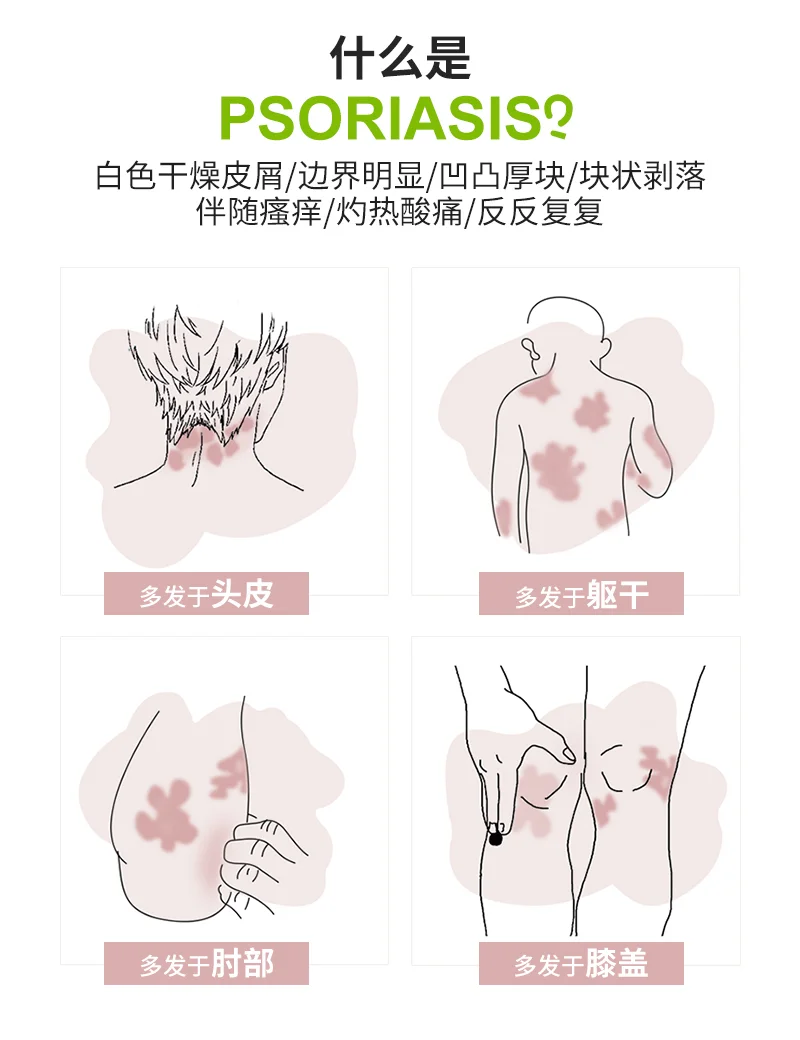 ?头皮银屑病，困扰何时休？