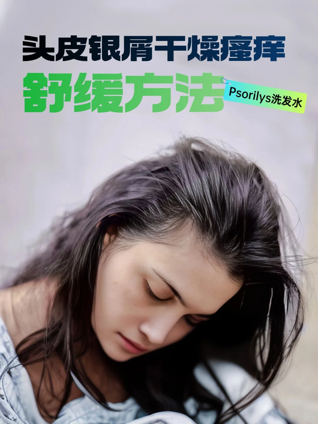 ?头皮银屑病，困扰何时休？