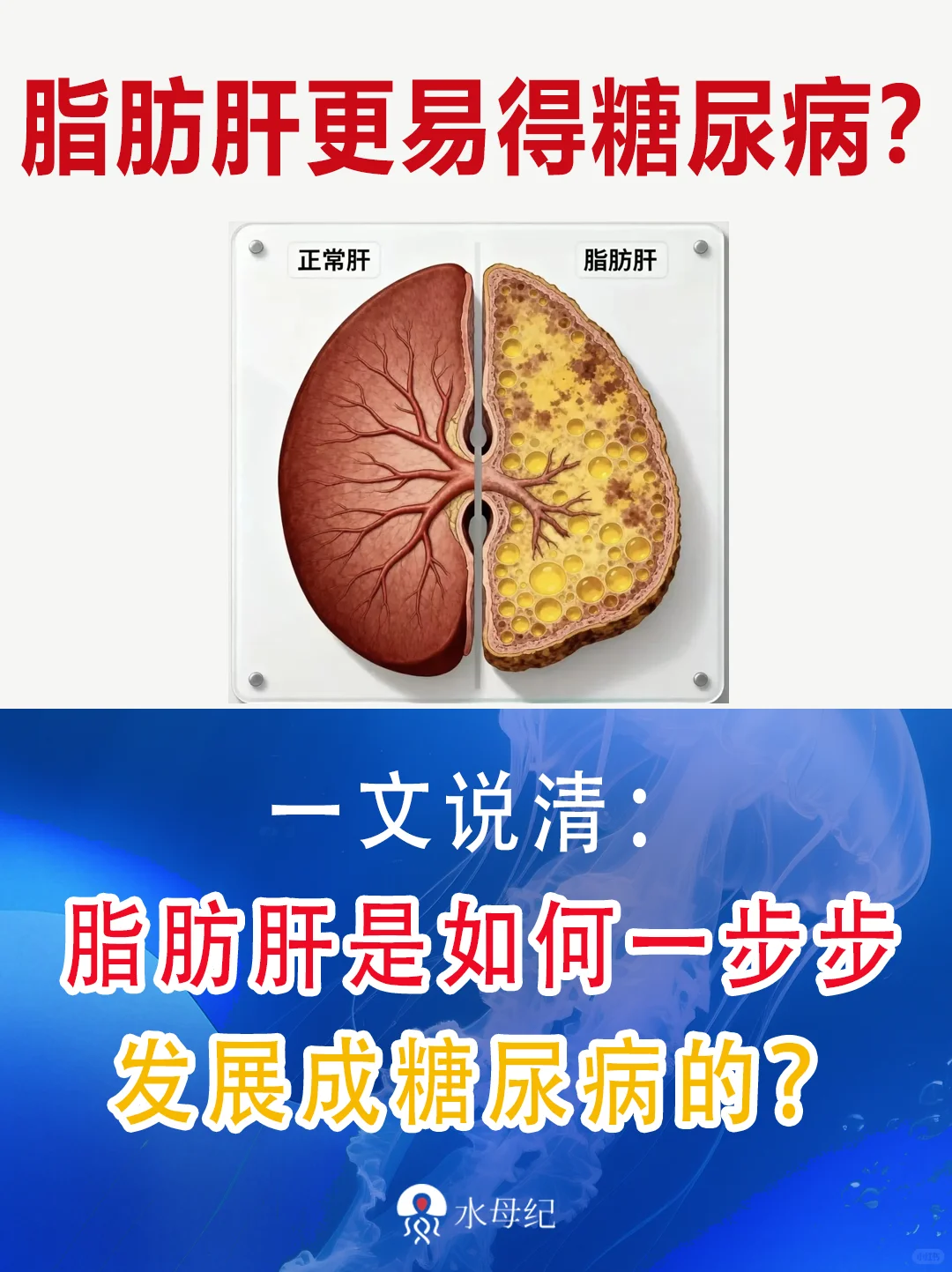 脂肪肝是如何发展成糖尿病的？