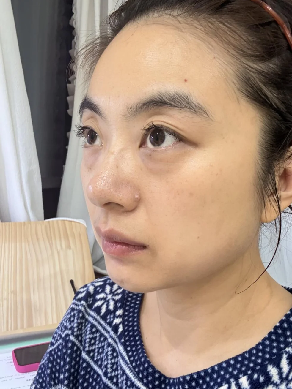 泪沟凹陷打了一支胶原蛋白，效果确实不一样