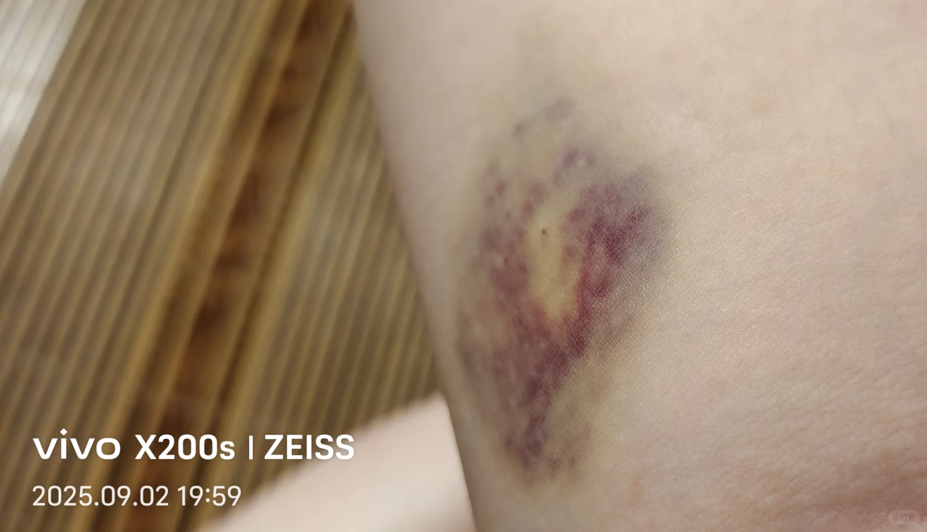 厂里体检卫生院的人来抽血.