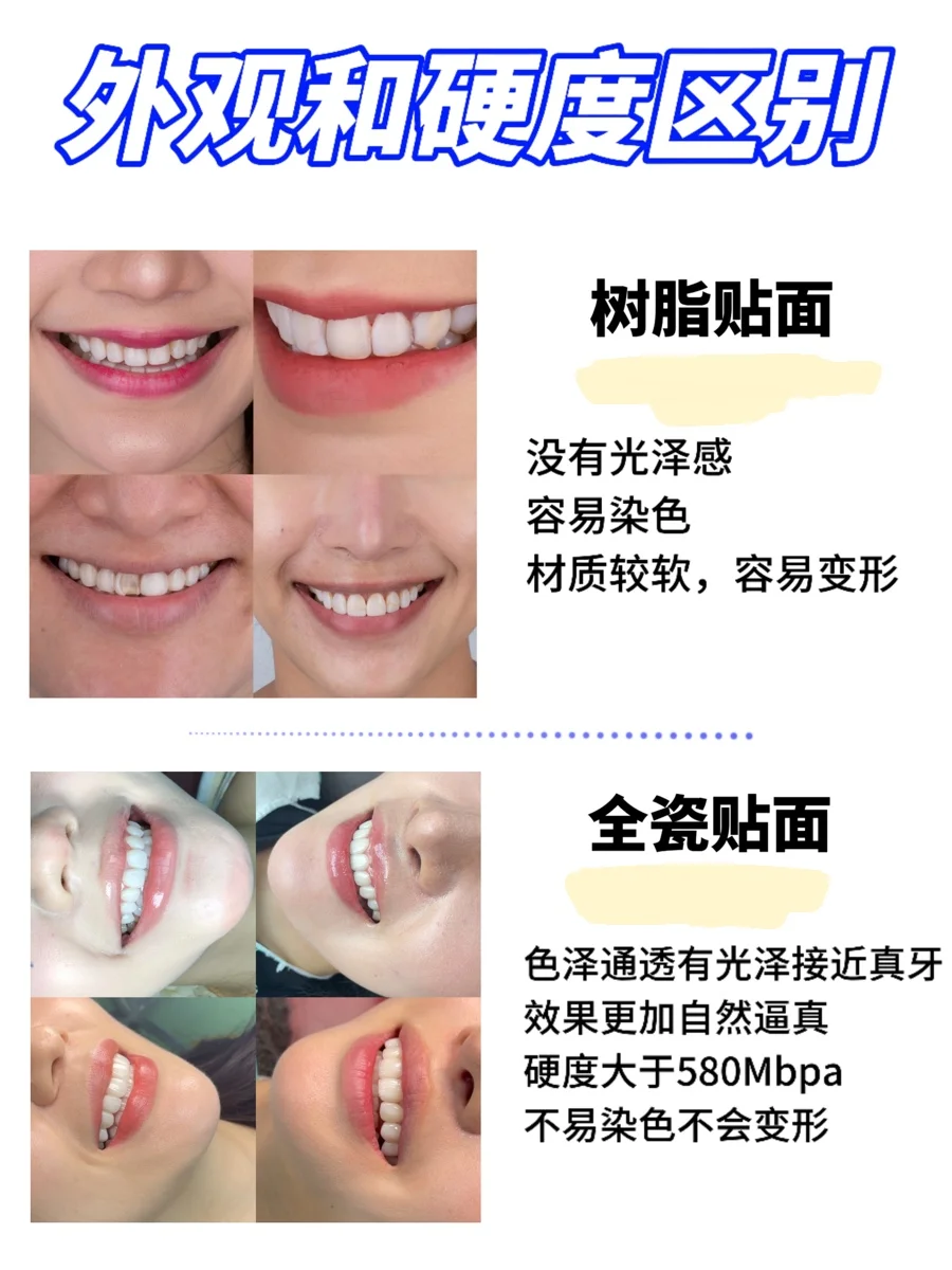 树脂贴面和全瓷贴面的区别在哪❓