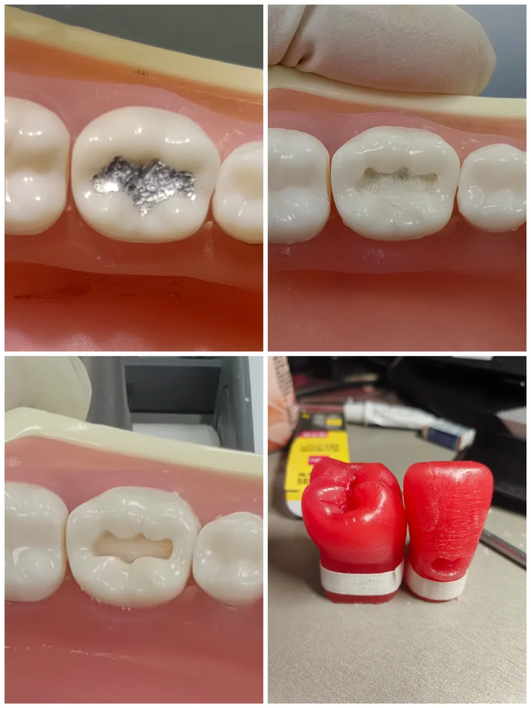 口腔医学实验——窝洞预备与银汞合金充填