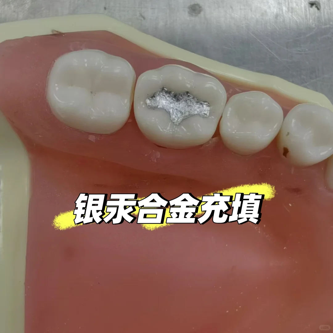 口腔医学实验——窝洞预备与银汞合金充填