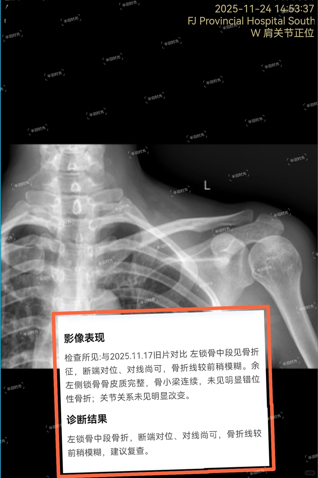 记录锁骨中段骨折第2️⃣1️⃣天‖11月24日
