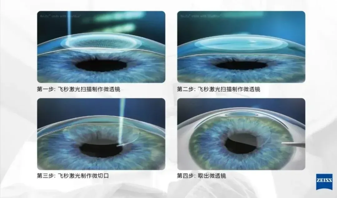 高考后来聊下近视激光手术:拼完分数再拼视力【科普时光】(转自温医大眼视光)-第3张图片-四季读书网