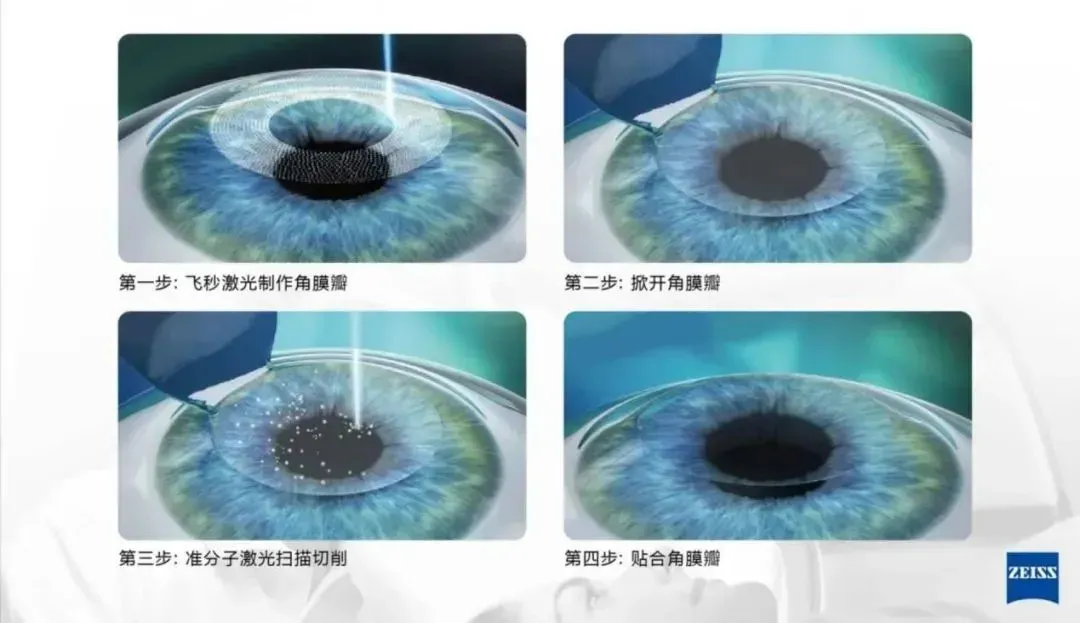 高考后来聊下近视激光手术:拼完分数再拼视力【科普时光】(转自温医大眼视光)-第4张图片-四季读书网