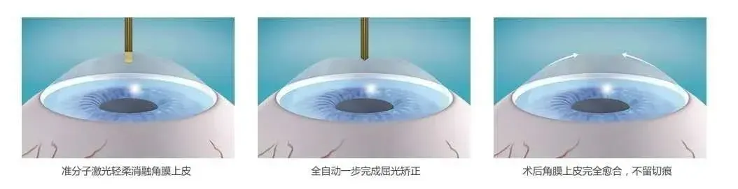 高考后来聊下近视激光手术:拼完分数再拼视力【科普时光】(转自温医大眼视光)-第5张图片-四季读书网