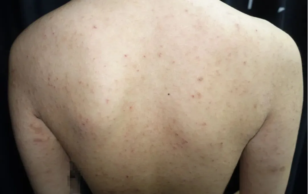 杭州27岁女子旅游后浑身瘙痒、起红疹,拖了一年也没治好!这种病传染性极强,多注意……