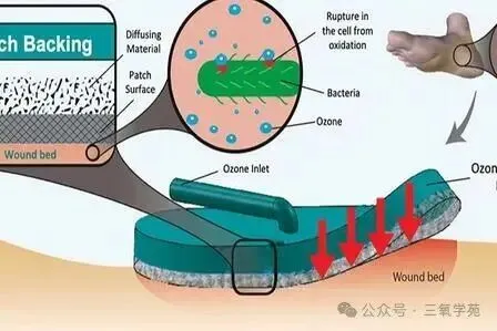 臭氧用于慢性溃疡的医学文献循证检索分析报告
