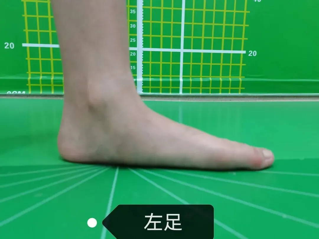 华南病案 | 冲刺体育中考jio疼?一查,脚上多了块骨头…… 第5张