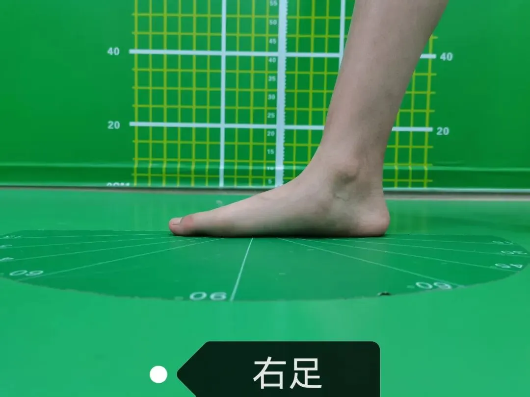 华南病案 | 冲刺体育中考jio疼?一查,脚上多了块骨头…… 第6张