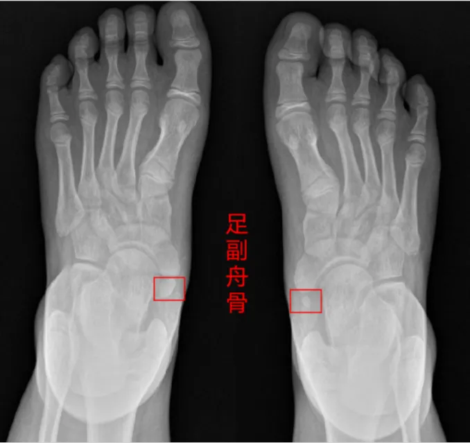 华南病案 | 冲刺体育中考jio疼?一查,脚上多了块骨头…… 第7张