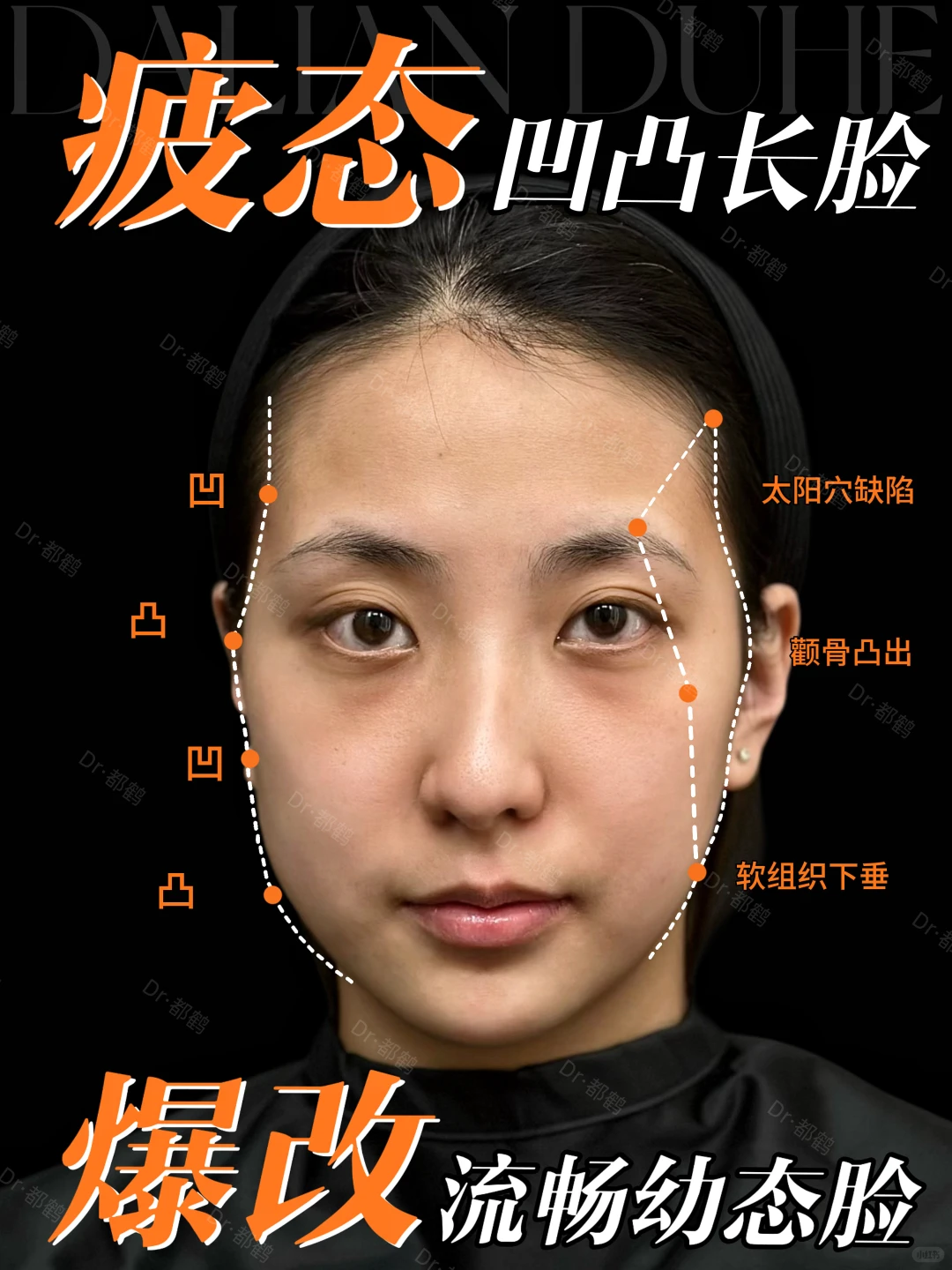 大连注射｜长脸💦轮廓凹凸凹的姐妹进
