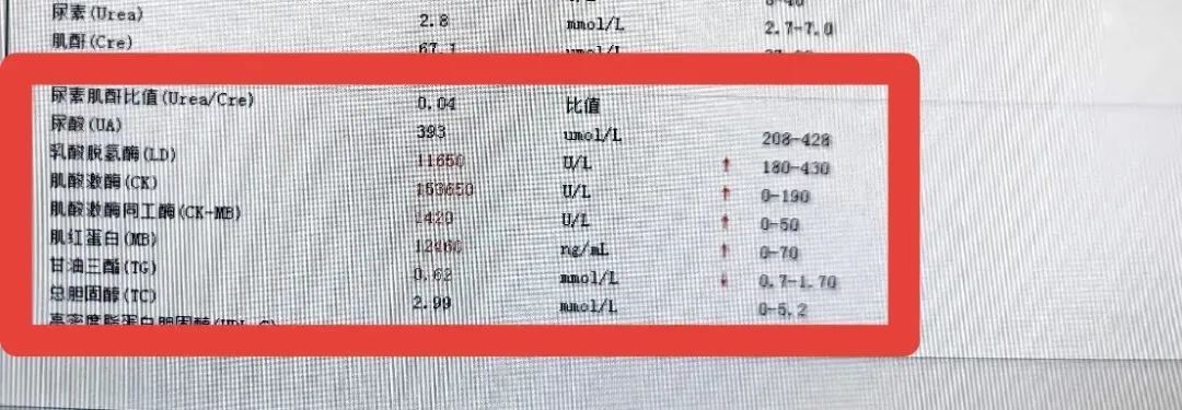 14岁男生冲刺中考体育,狂练2小时游泳,竟致“酱油尿”紧急住院,被确诊为 “横纹肌溶解症”,医生:极易引发急性肾功能衰竭 第2张