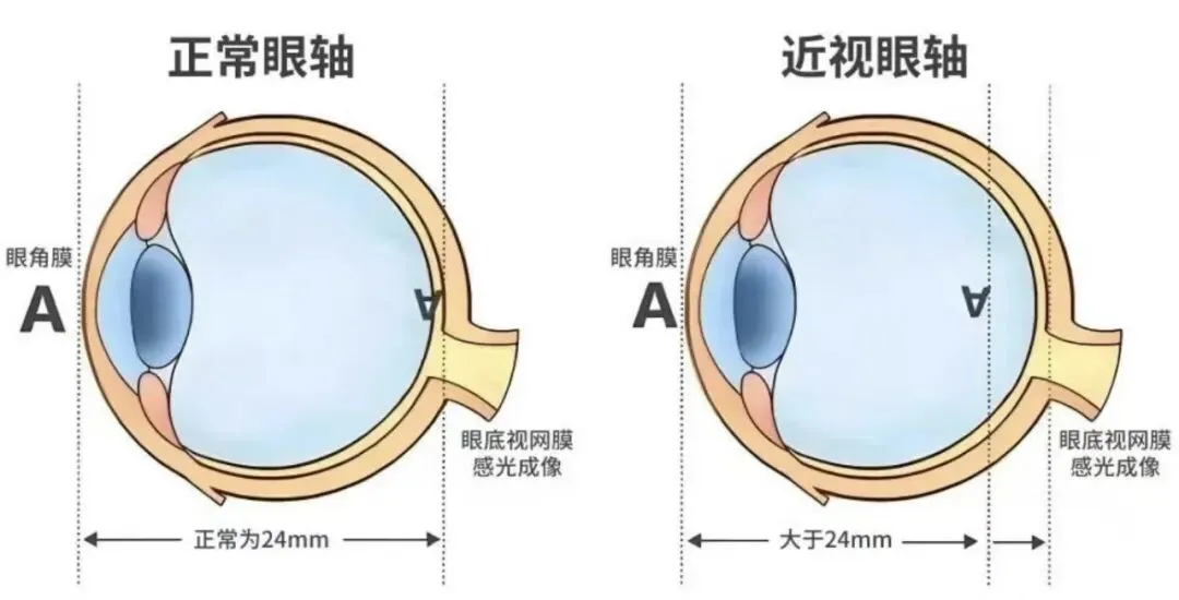 中考后,别让孩子的视力 “放假” 第4张