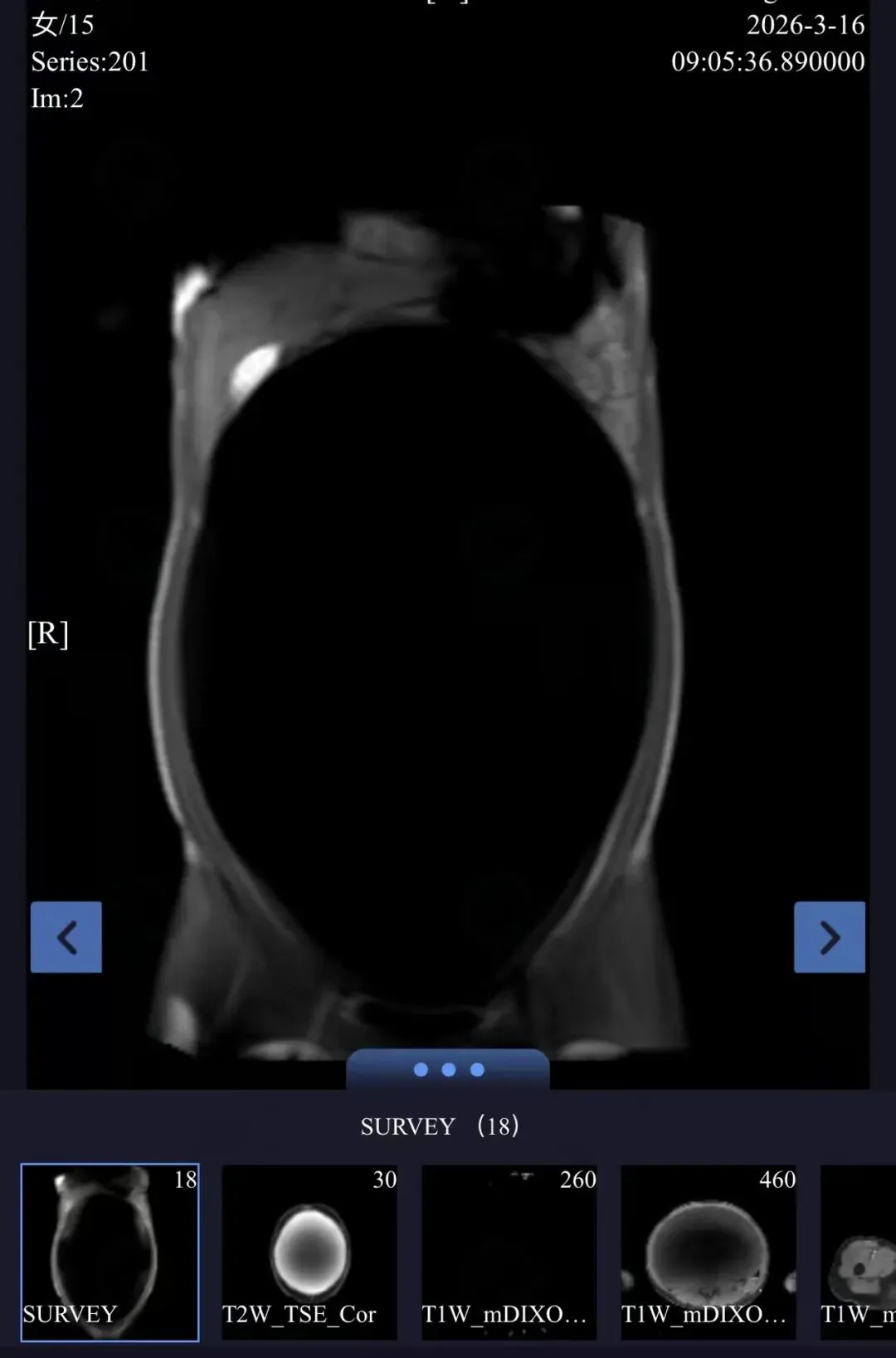 中考在即少女腹中竟藏篮球般肿瘤,医生团队精准研判,单孔微创精准为备考“抢”时间 第1张